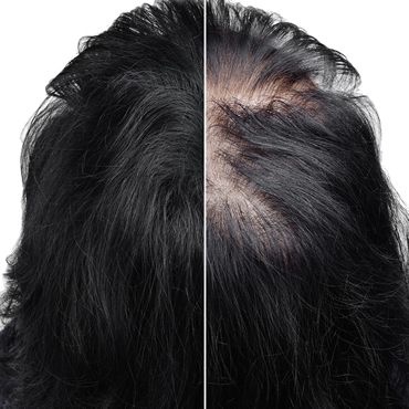 Hair Loss Treatment | Kew Medical %Hair loss treatment Men and Women